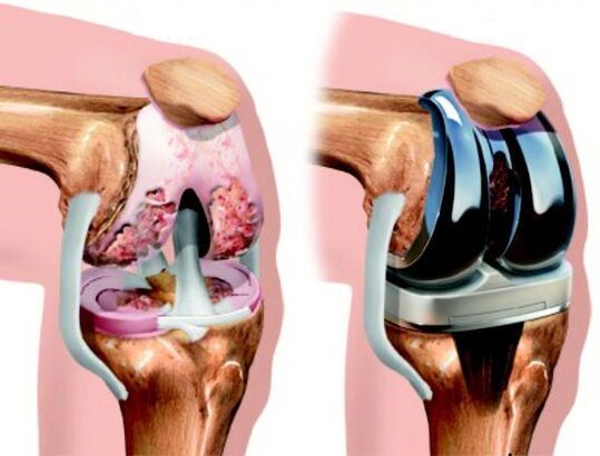 Outcome of knee replacement surgery for arthrosis