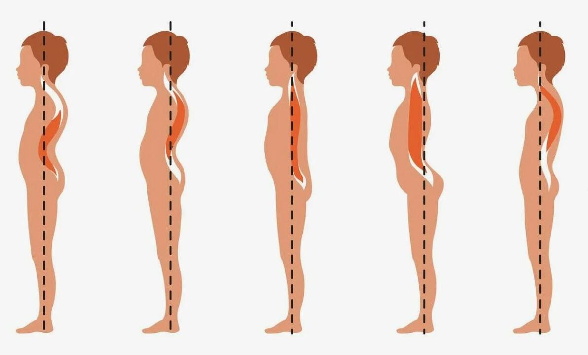 the degree of development of lumbar osteochondrosis