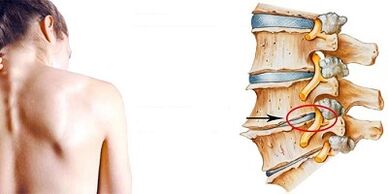 Cervical osteocondrosis development mechanism