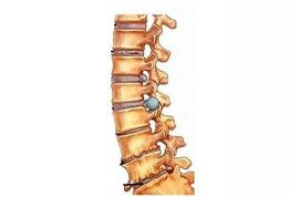 Stages of cervical osteocondrosis