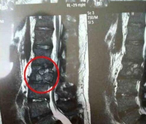 The spinal tumor in the picture