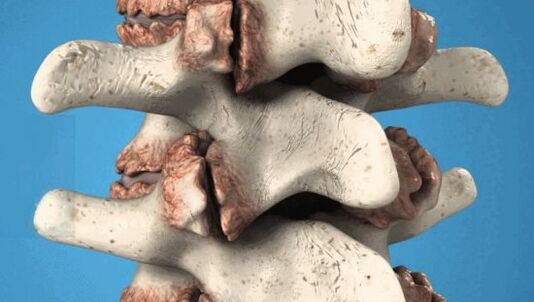 Vertebrae's osteoophyte - Pathological growth that harms nerves and blood vessels