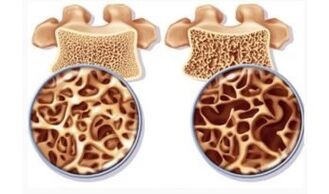 The threat of cervical suctions for women