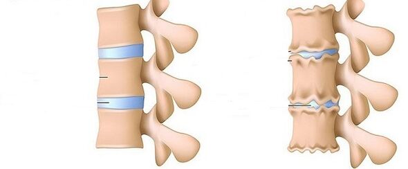 Healthy spine and osteocondrosis