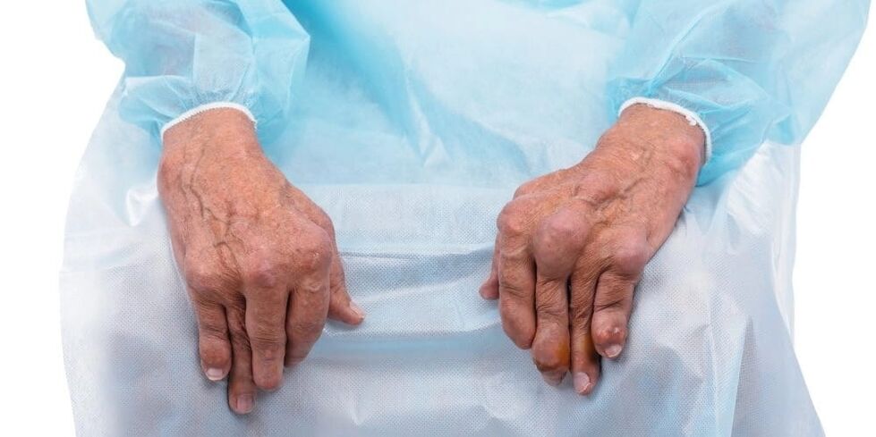 Infectious arthritis is a disease accompanied by constant pain and changes in the joints of the fingers.