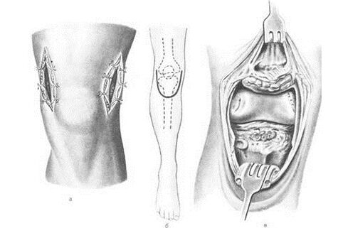 arthrotomy for arthrosis